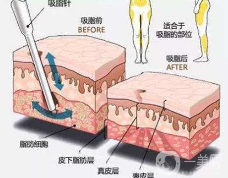 全身抽脂減肥價(jià)格大概要多少錢？