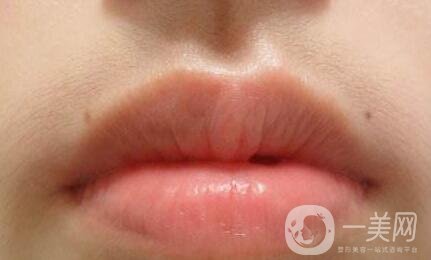 臉部脫毛手術(shù)大概需要多少錢？