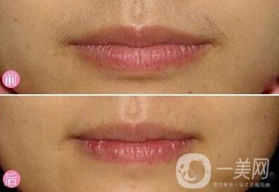 臉部脫毛手術(shù)大概需要多少錢？