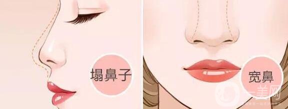 鼻頭縮小手術(shù)價(jià)錢是多少?有哪些縮小鼻頭的方法