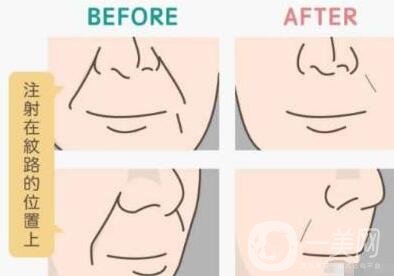 玻尿酸去法令紋多少錢?價格是多少?