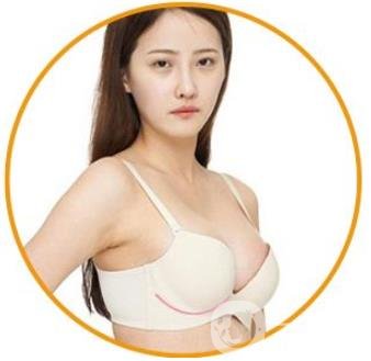 娜綺麗隆胸多久變軟？怎么加速變軟？