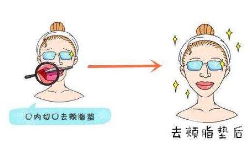 去頰脂墊*果怎么樣？*嗎？