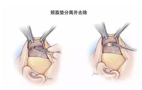 去頰脂墊*果怎么樣？*嗎？