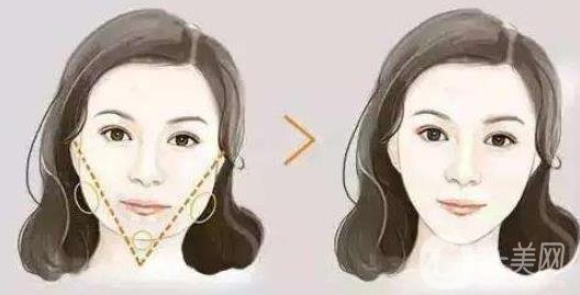 去頰脂墊*果怎么樣？*嗎？