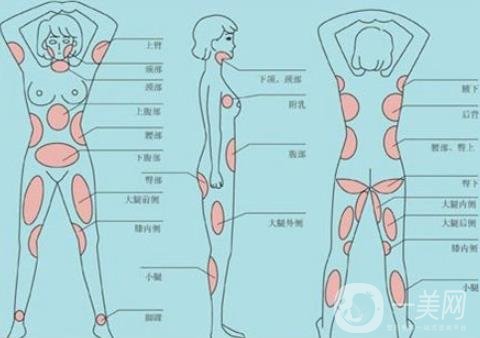 全身抽脂減肥多少錢？貴嗎？