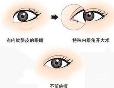 開(kāi)眼角手術(shù)過(guò)程中疼嗎?要多久?