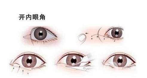 開(kāi)眼角手術(shù)過(guò)程中疼嗎?要多久?