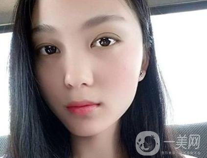 吸雕雙眼皮手術(shù)是什么？是埋線嗎？