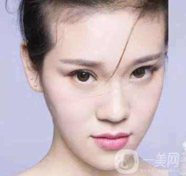 像素激光去痘的*果好嗎？會反彈嗎？