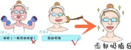 抽脂瘦臉手術(shù)*嗎?*果*嗎?