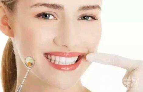 烤瓷牙的種類有哪些?哪種比較好?