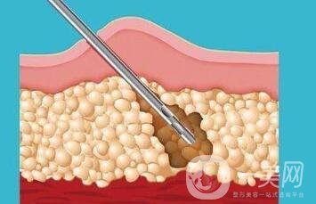 什么是環(huán)形吸脂減肥？?jī)?yōu)點(diǎn)有哪些？