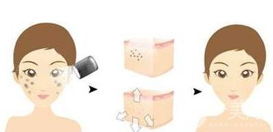 光子嫩膚的原理是什么？*果怎樣？