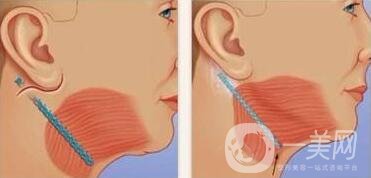 頸部除皺提升術(shù)要多少錢(qián)？貴不貴？