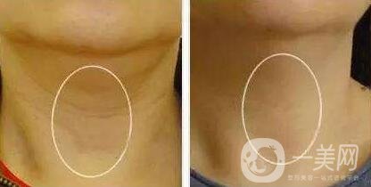 頸部除皺提升術(shù)要多少錢(qián)？貴不貴？