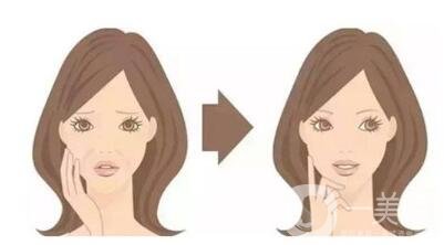 頸部除皺提升術(shù)要多少錢(qián)？貴不貴？