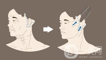 頸部除皺提升術(shù)要多少錢(qián)？貴不貴？