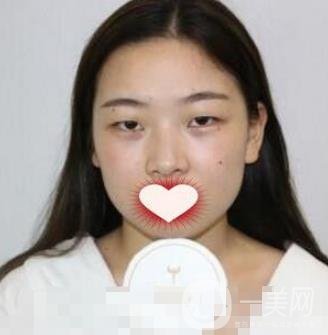 西南醫(yī)院整形美容外科雙眼皮