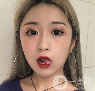 西安葉子整形美容醫(yī)院雙眼皮