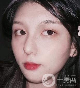 六盤水友好整形醫(yī)院雙眼皮