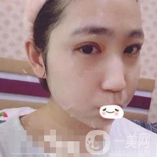 濟南旭美整形醫(yī)院靠譜嗎?附雙眼皮案例和全新價格表