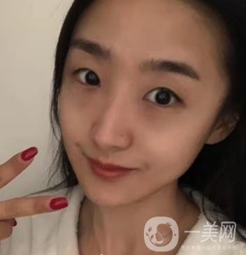 吉大一院整形外科價(jià)格表明細(xì)公布，隆鼻紀(jì)實(shí)案例分享