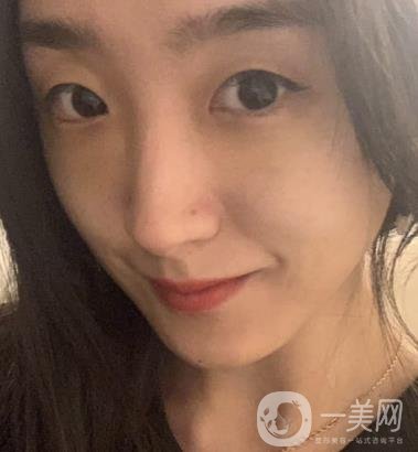 吉大一院整形外科價(jià)格表明細(xì)公布，隆鼻紀(jì)實(shí)案例分享