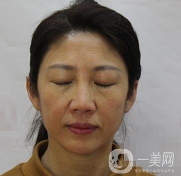 安徽醫(yī)科大學(xué)第(一)附屬醫(yī)院整形外科價格表，附去眼袋案例