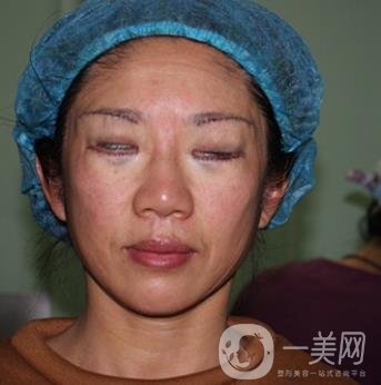 安徽醫(yī)科大學(xué)第(一)附屬醫(yī)院整形外科價格表，附去眼袋案例