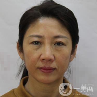 安徽醫(yī)科大學(xué)第(一)附屬醫(yī)院整形外科價格表，附去眼袋案例