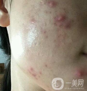 江門(mén)夢(mèng)想整形醫(yī)院去痘印需要多少錢(qián)?價(jià)格表和真人整形日記一覽