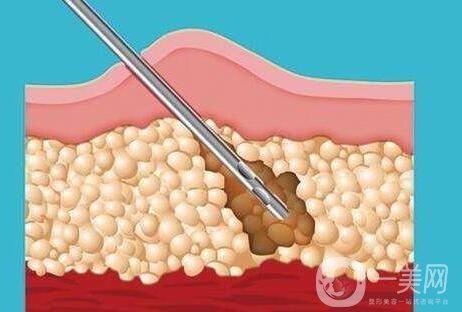 關(guān)于吸脂手術(shù)的流程與*性，你都知道嗎？