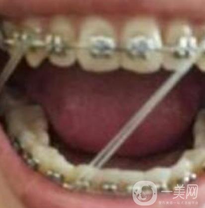 張家港澳洋醫(yī)院整牙