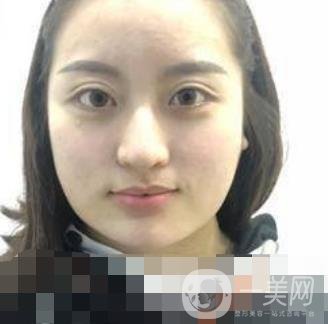 河北省人民醫(yī)院整形外科價(jià)格表新版來襲，附去下頜骨案例