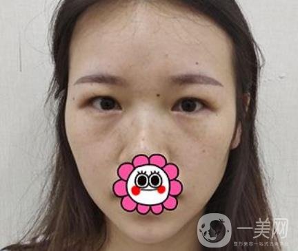 金華中心醫(yī)院整形美容科價格表+割雙眼皮案例一覽