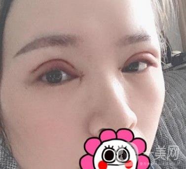 金華中心醫(yī)院整形美容科價格表+割雙眼皮案例一覽