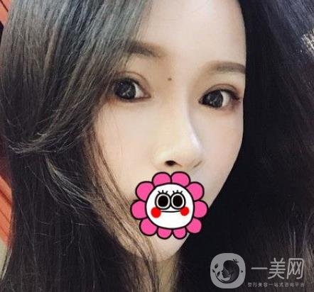 金華中心醫(yī)院整形美容科價格表+割雙眼皮案例一覽