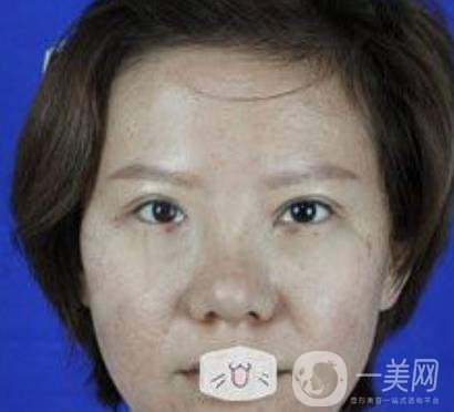 綿陽(yáng)中心醫(yī)院整形美容科價(jià)格表2020發(fā)布，附祛眼袋案例