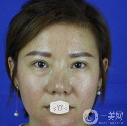 綿陽(yáng)中心醫(yī)院整形美容科價(jià)格表2020發(fā)布，附祛眼袋案例