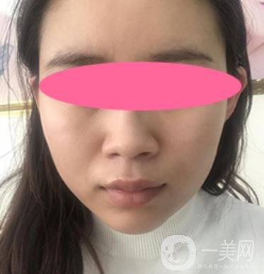 寧波第一醫(yī)院整形科價(jià)格表收費(fèi)明細(xì)上線，看打玻尿酸真人案例