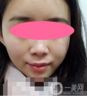 寧波第一醫(yī)院整形科價(jià)格表收費(fèi)明細(xì)上線，看打玻尿酸真人案例