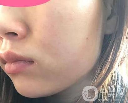 寧波第一醫(yī)院整形科價(jià)格表收費(fèi)明細(xì)上線，看打玻尿酸真人案例