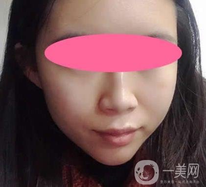 寧波第一醫(yī)院整形科價(jià)格表收費(fèi)明細(xì)上線，看打玻尿酸真人案例