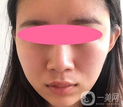 寧波第一醫(yī)院整形科價(jià)格表收費(fèi)明細(xì)上線，看打玻尿酸真人案例