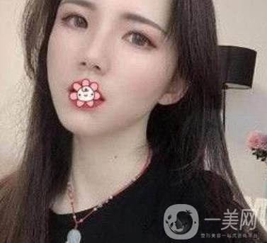 上海第九人民醫(yī)院整形外科價格表，附面部脂肪填充案例