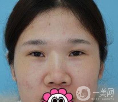 2020北京大學(xué)深圳醫(yī)院整形科價(jià)格表，附雙眼皮案例