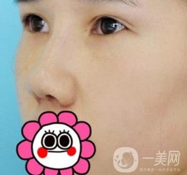 2020北京大學(xué)深圳醫(yī)院整形科價(jià)格表，附雙眼皮案例