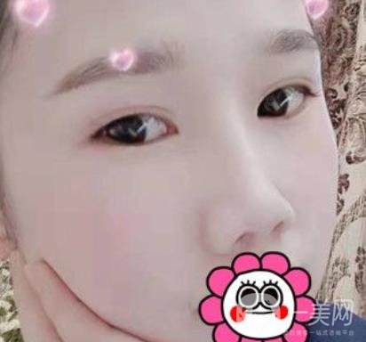 2020北京大學(xué)深圳醫(yī)院整形科價(jià)格表，附雙眼皮案例