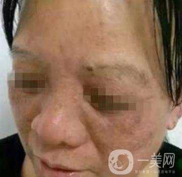 廣東省人民醫(yī)院整形科價(jià)格表，附祛斑整形日記